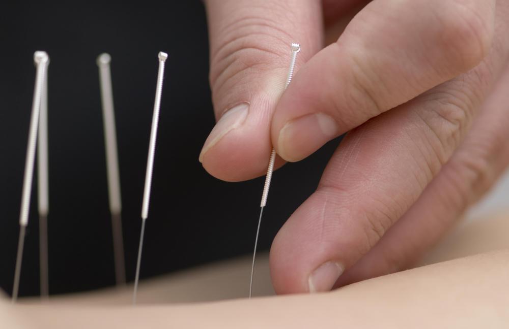 Acupuncture needles can be steel, silver or gold.