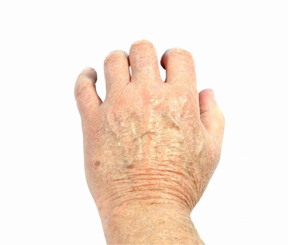 Skin conditions such as eczema can be treated with Noxzema®.