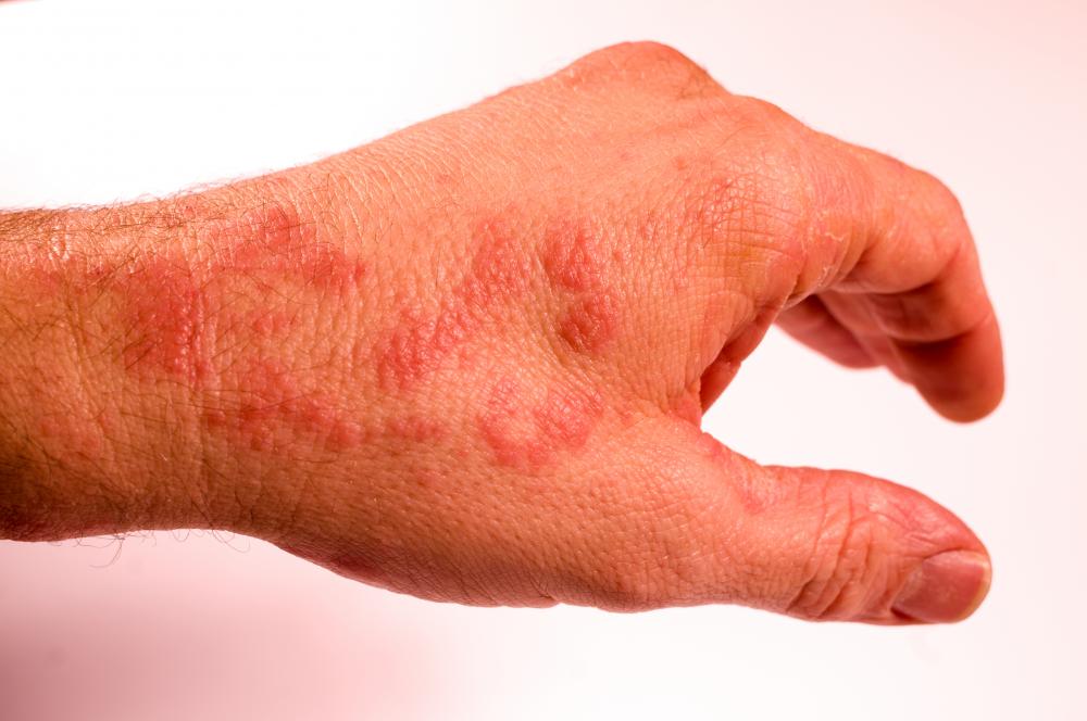 A dermatologist treats patients with rashes.