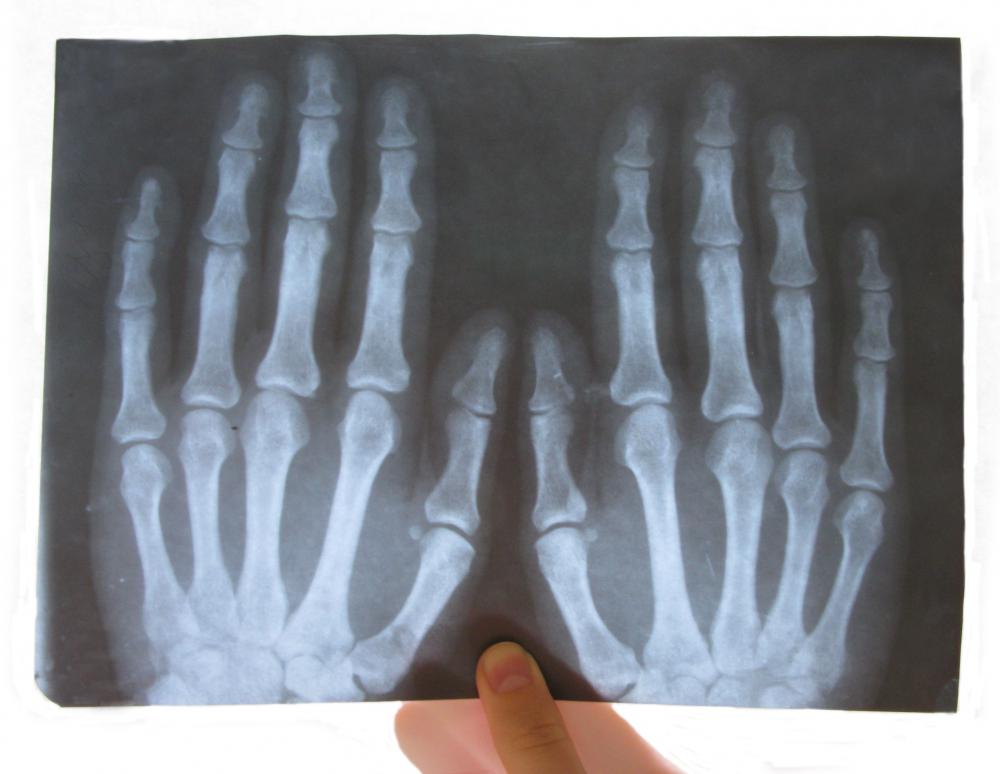The metacarpophalangeal joint, or MCP joint, is one of five joints in each hand that connect the metacarpal bones in the palm to the phalangeal bones in the five fingers.