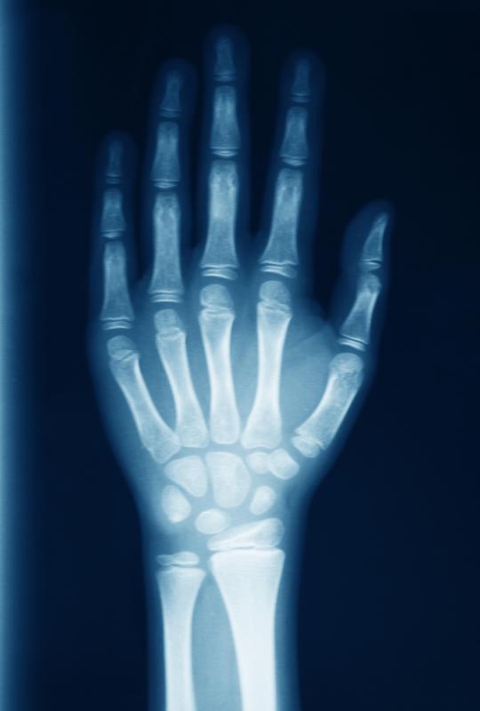 A doctor will usually take an x-ray to determine the best treatment for a dislocated thumb.