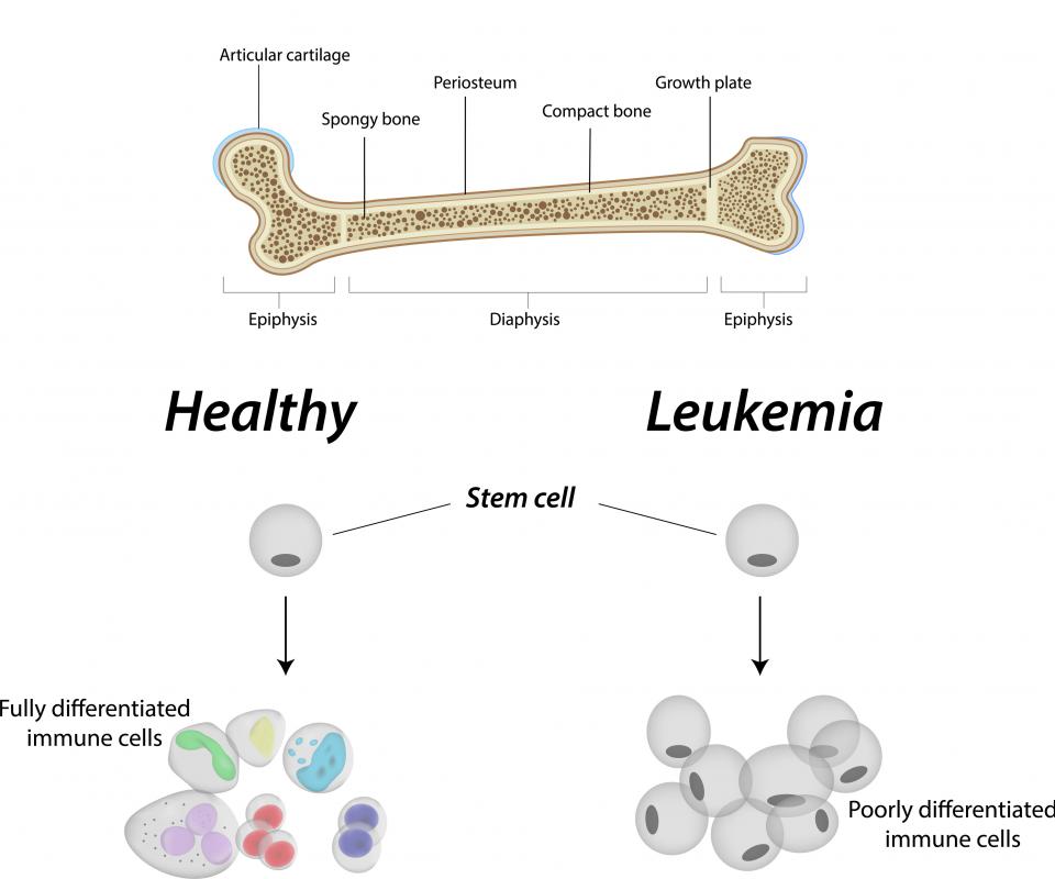 Leukemia results when too many white blood cells stay as blast cells in the bone marrow.