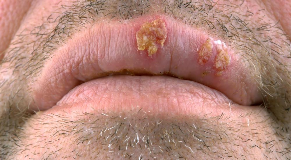Herpes may cause tingling lips.