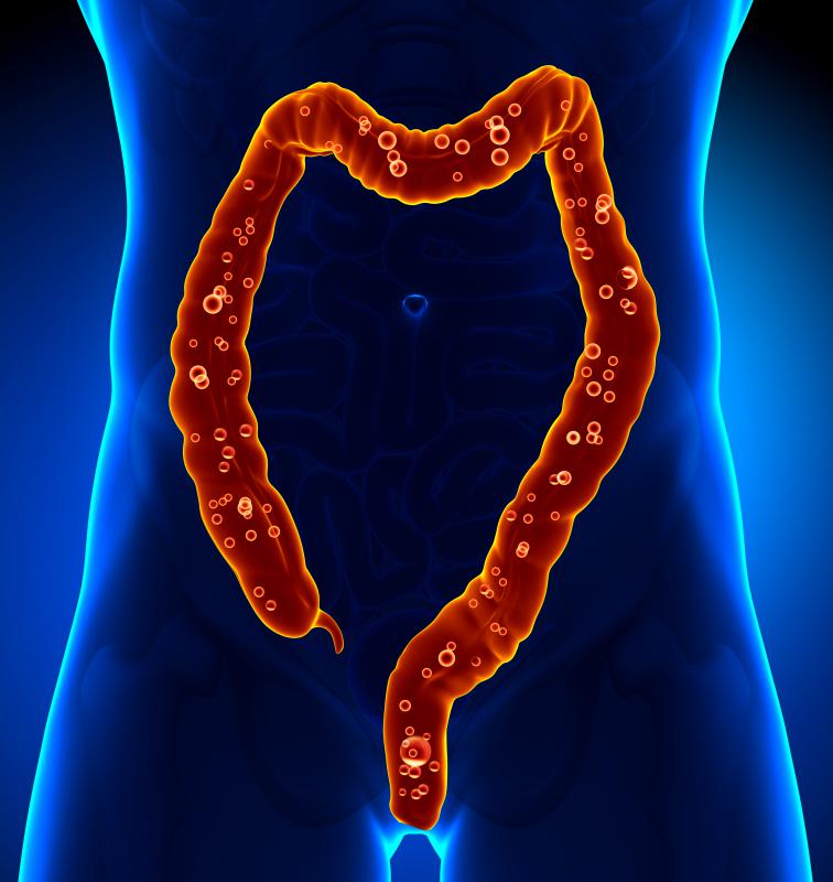 The main symptom of diverticulitis is the presence of fluid-filled lumps in the intestines.