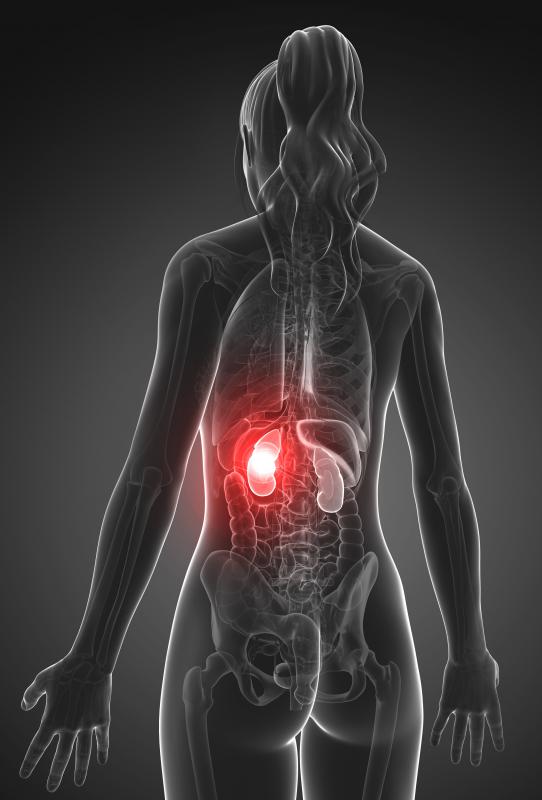 Kidney failure may be a symptom of myeloma.