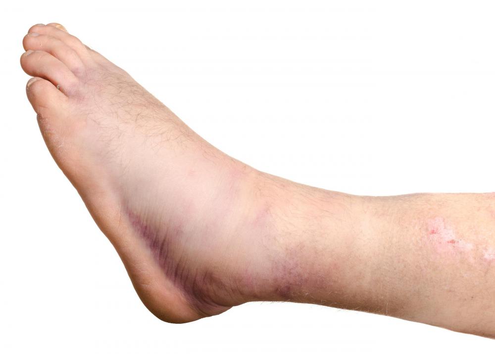 A vasculitis rash may appear on the ankles.