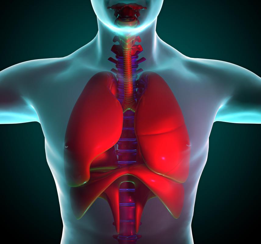 Bullous emphysema occurs when air sacs in the lungs become severely enlarged.