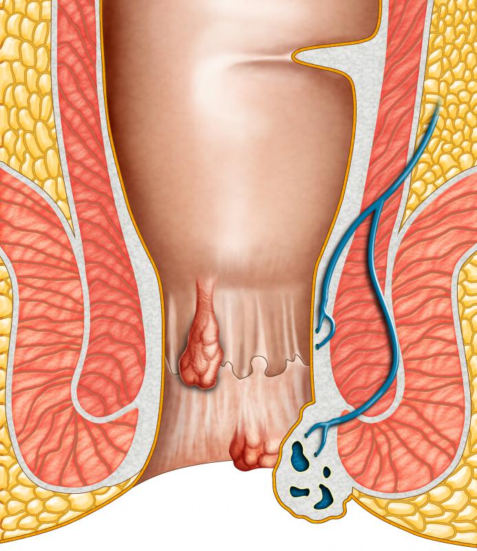 A rectal dilator may be used to treat hemorrhoids.