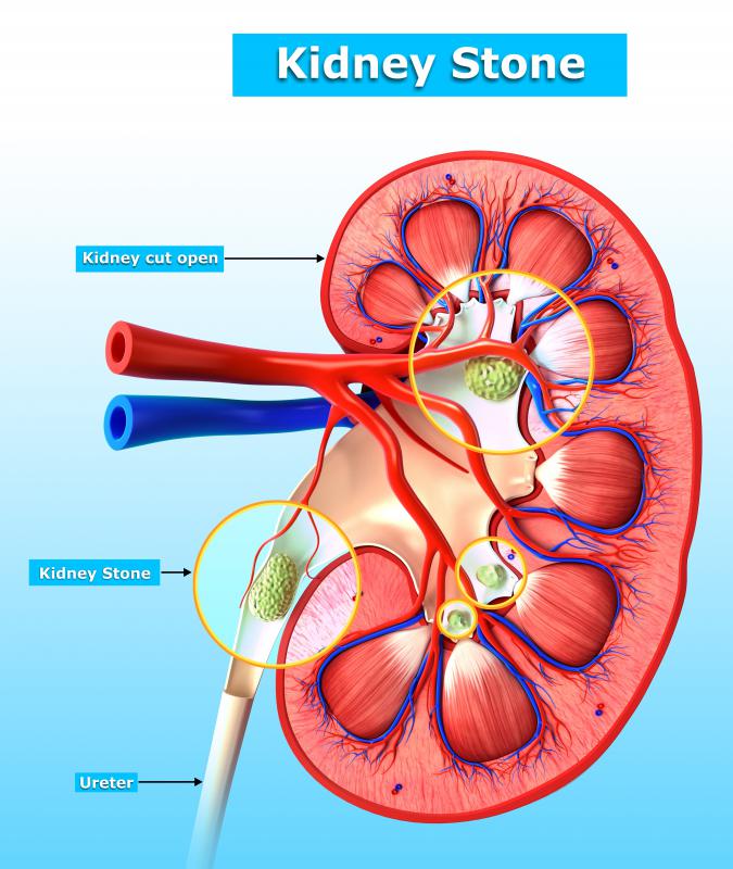 The presence of kidney stones makes someone more susceptible to developing a urothelial neoplasm.