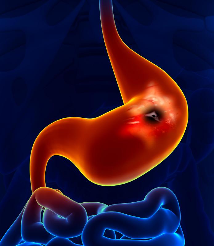 Duodenal mucosa can be affected by peptic ulcer disease.