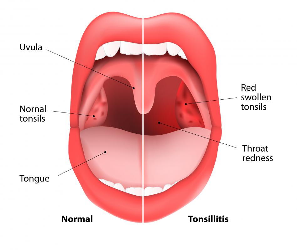 Inflammation of the tonsils is referred to as tonsillitis.