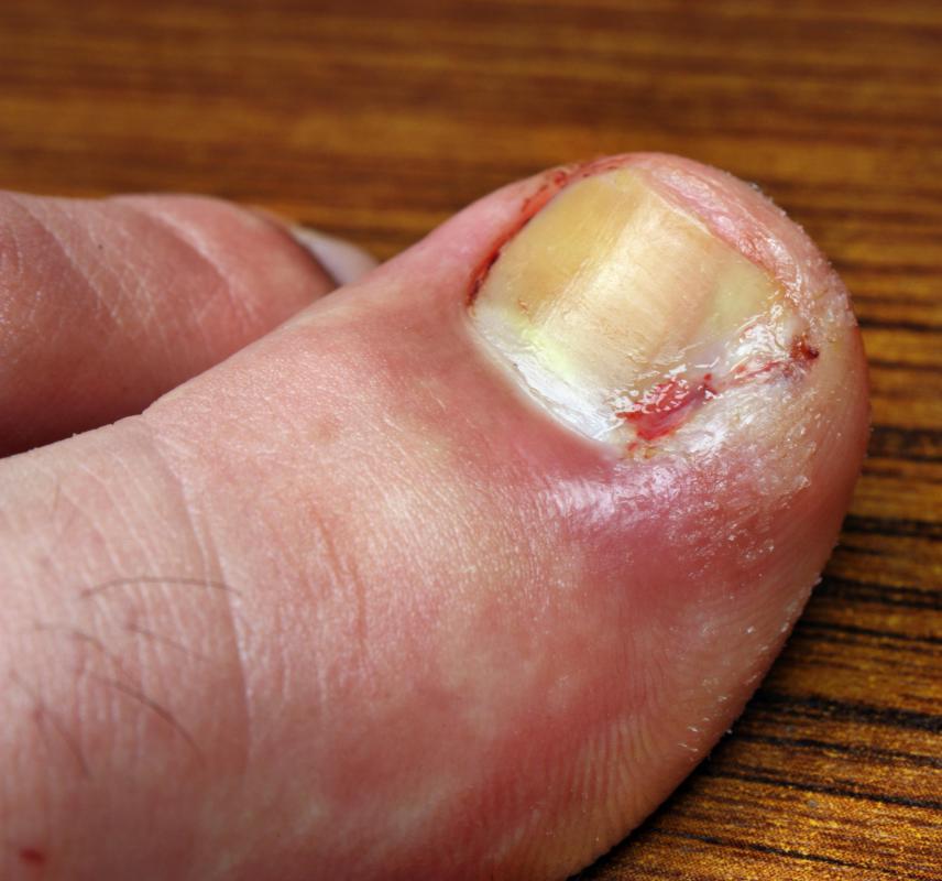 Toenail clippers should generally not be shared, so as to avoid the risk of developing a toenail infection.
