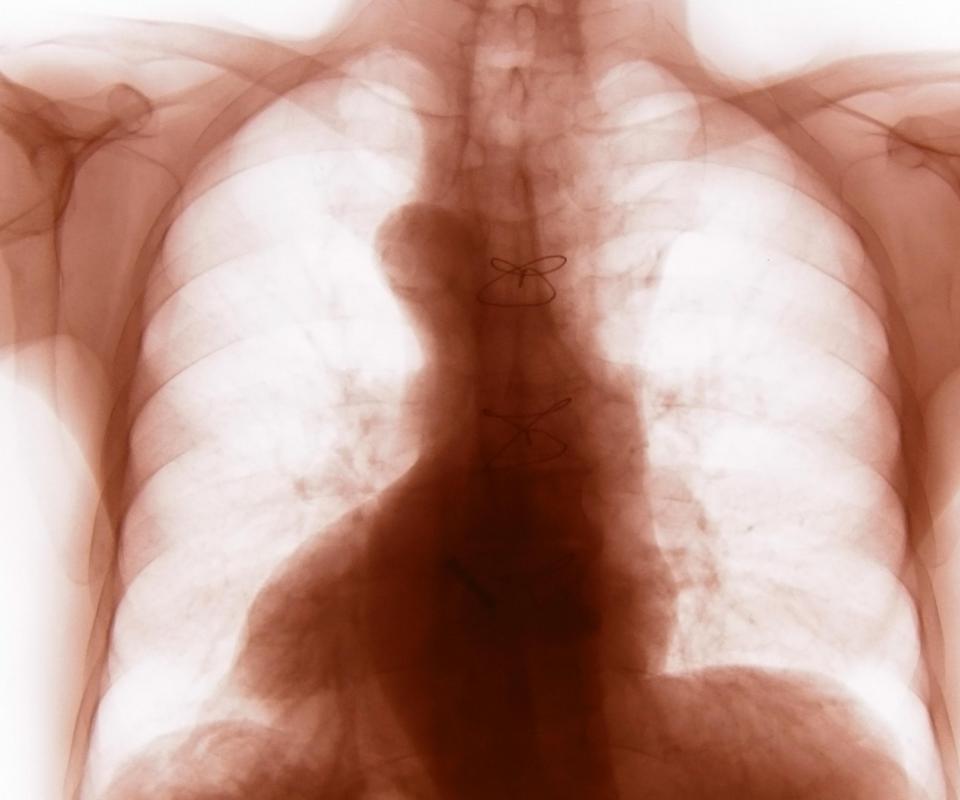 A patient’s sternal wires may be checked with x-rays to make sure they are not damaging the sternum.