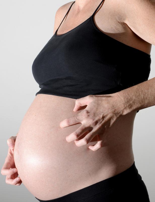Pregnancy may cause flare ups of cutaneous lupus.