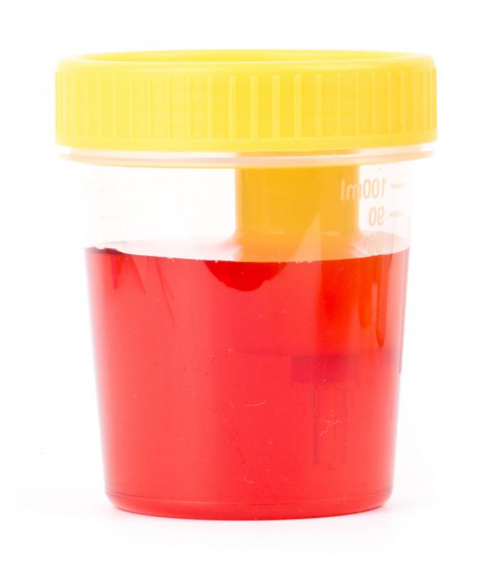 Symptoms of kidney lesions may include blood in the urine.