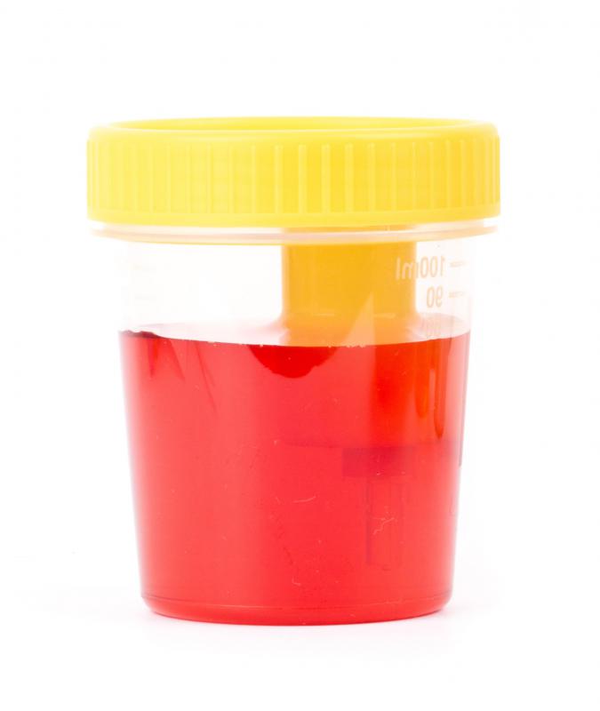 TURBT surgery can cause bloody urine.