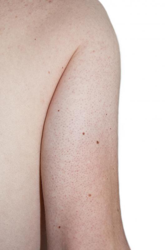 Keratosis pilaris is treatable and not a serious condition.