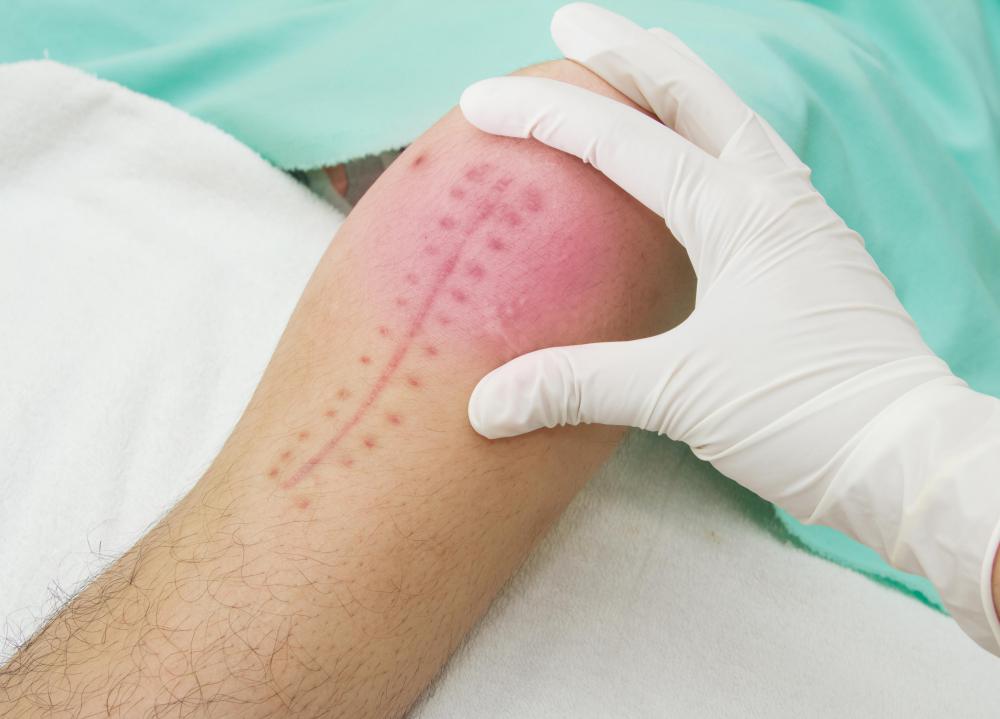 Surgical wounds can be closed with regular sutures or dissolvable ones.
