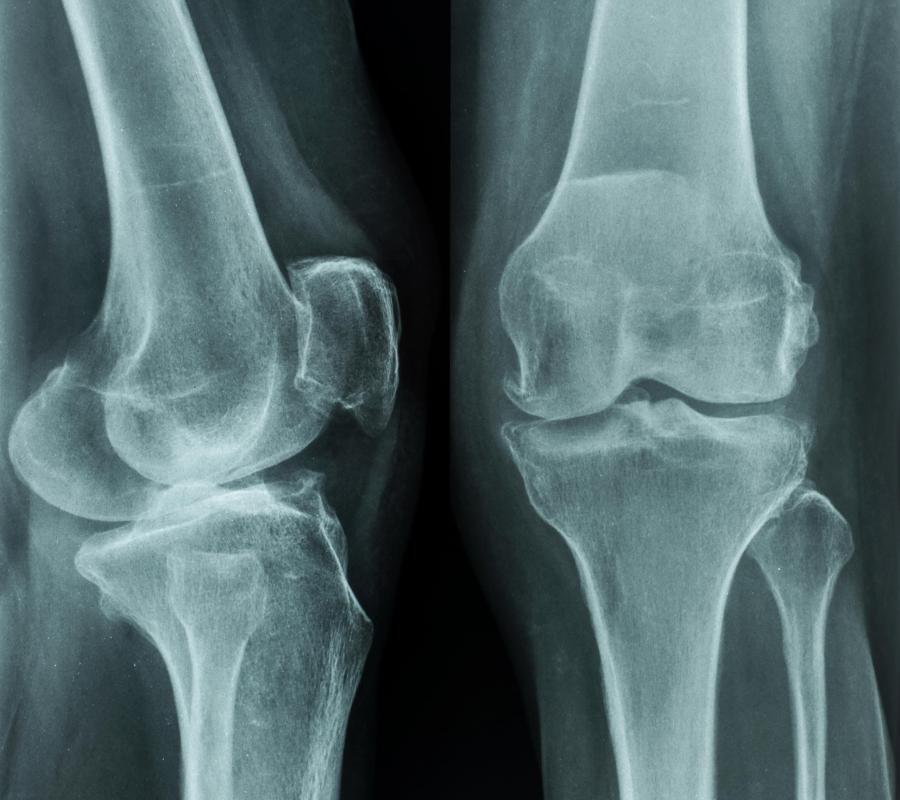 X-rays of the knee may be necessary to diagnose genu recurvatum.