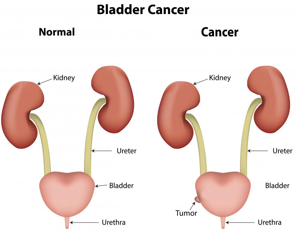 Bladder cancer is a major type of bladder mass that is much more common in men than in women.