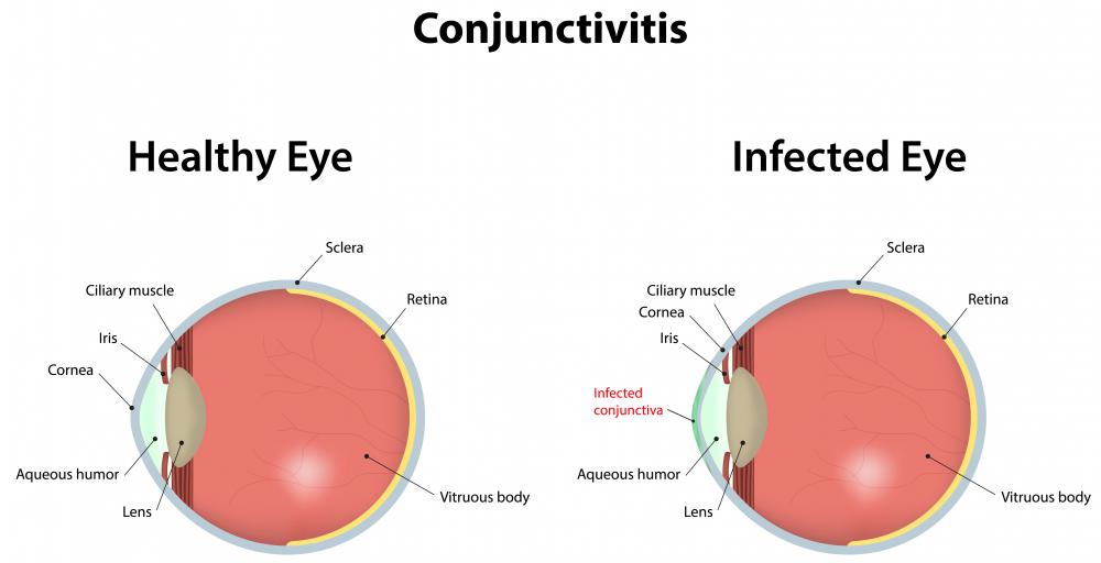 Conjunctivitis is an infection of the eye.