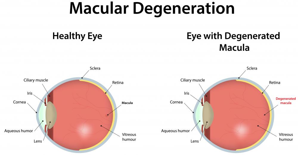 Retinal implants may be necessary because of macular degeneration.