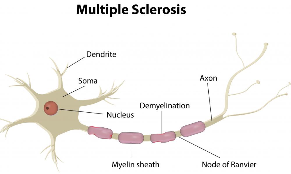Use of telegraphic speech without explanation may be a sign of multiple sclerosis.