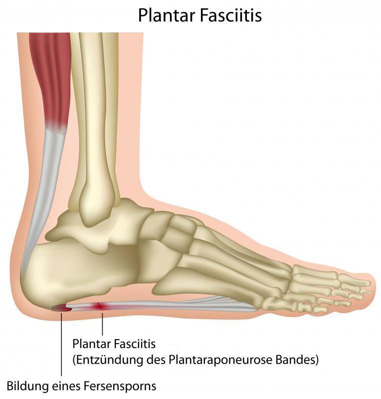 Bone spurs can occur in the ankle bone, and the result is a medical condition known as plantar fasciitis.