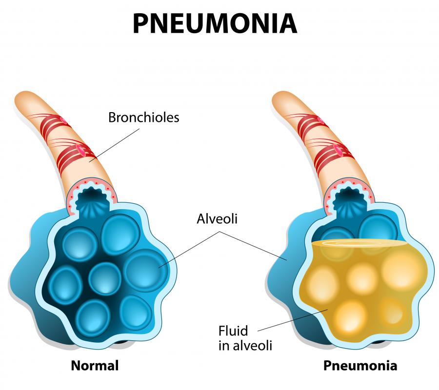 Dulcamara may be beneficial to those who are susceptible to pneumonia.