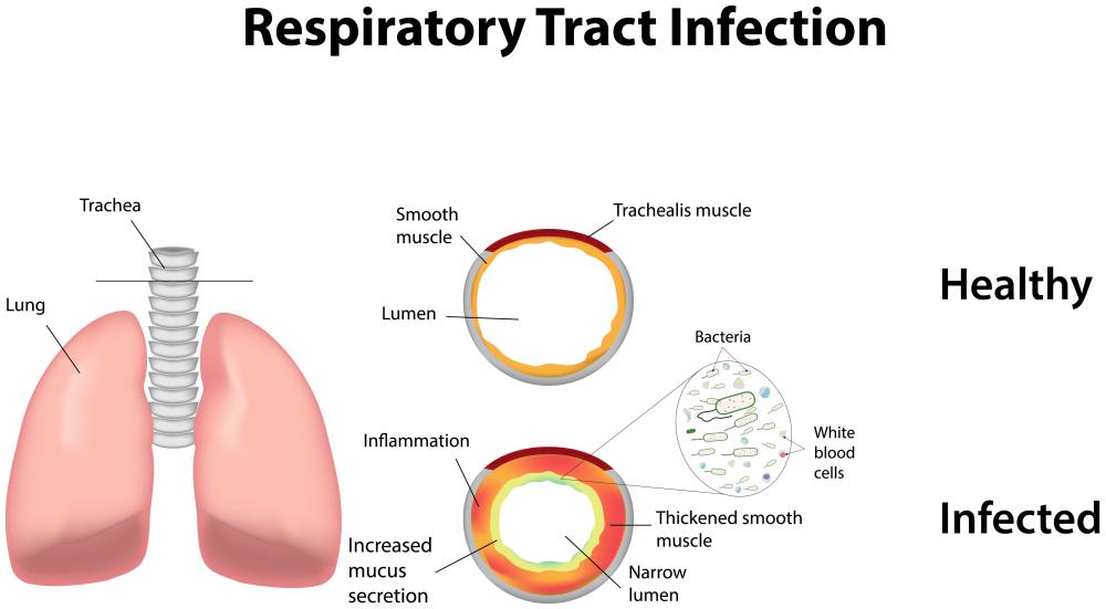 A sputum test may be performed to diagnose a lower respiratory tract infection and a variety of other conditions.