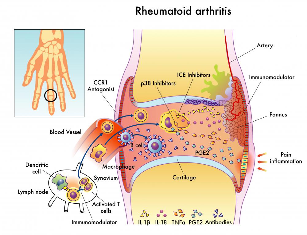 Those with rheumatoid arthritis can benefit from peptide therapy.