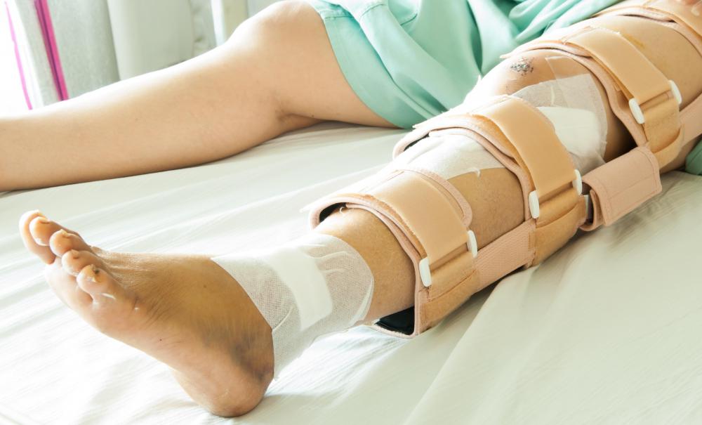 Treatment for a lateral condyle fracture in the tibia often requires setting and immobilizing the leg.
