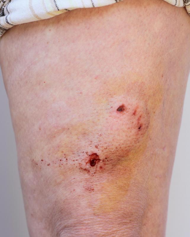Antibiotic ointments, which may be applied to sores to prevent infection, are typically differentiated from antibacterial locations.