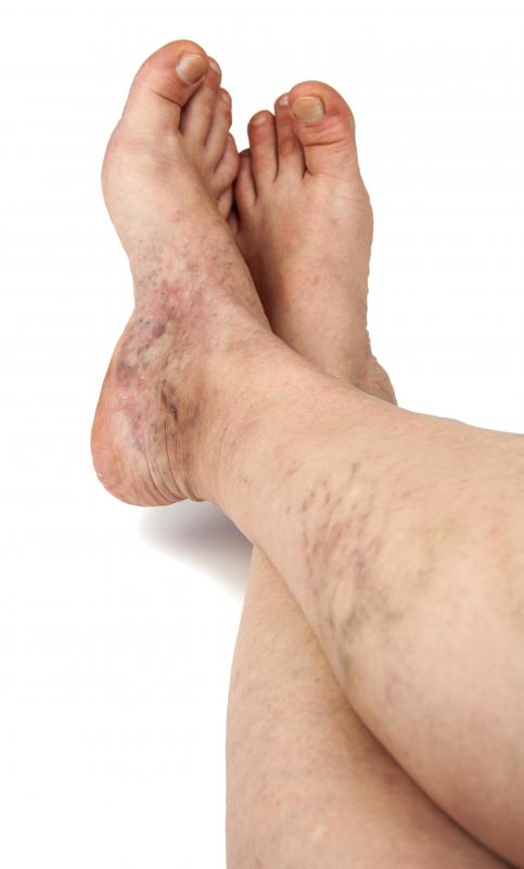 Thermocoagulation may be used to treat spider veins.