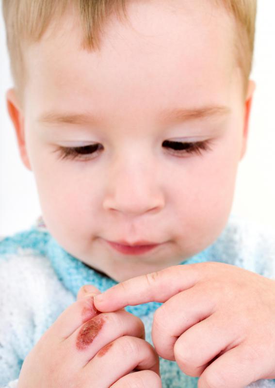 Two seconds of exposure to water at 150 degrees will severely burn a child.