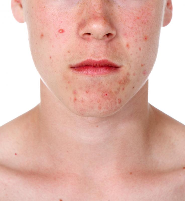 Non-comedogenic moisturizer may be used to help fight acne.