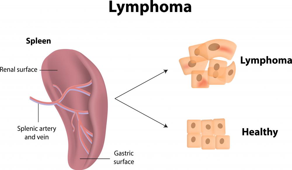 The presence of paraproteins in the blood or urine may be indicative of lymphoma.
