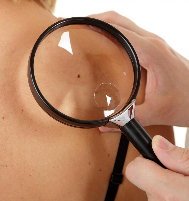 Because they have the potential to become skin cancer, a person should consistently check moles for signs of cancer.