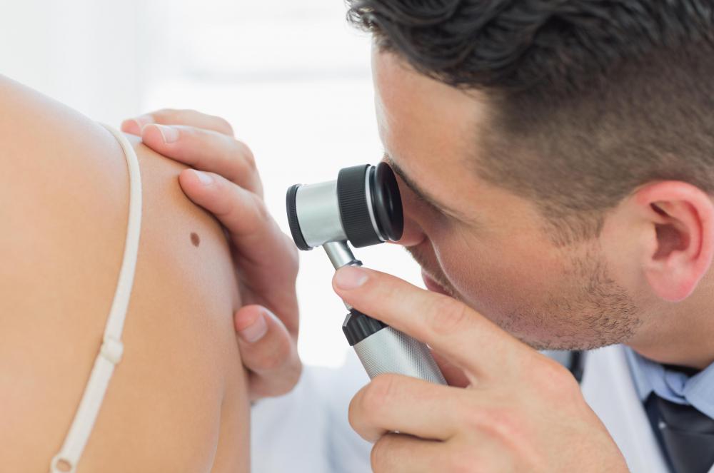 A doctor may recommend removal and biopsy of a mole to determine if it is malignant.