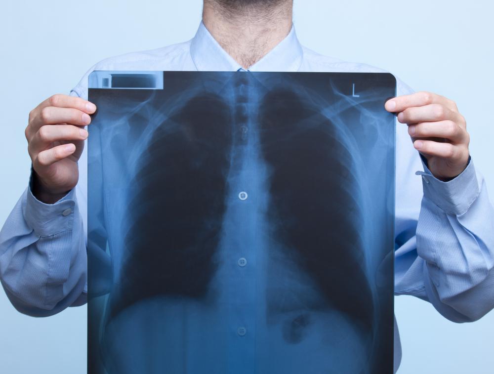 A chest X-ray may be performed immediately after a pleural tap to ensure the lungs have not been damaged.