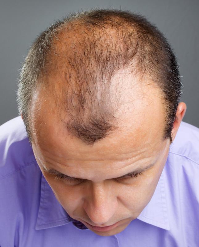 A man with thinning hair.