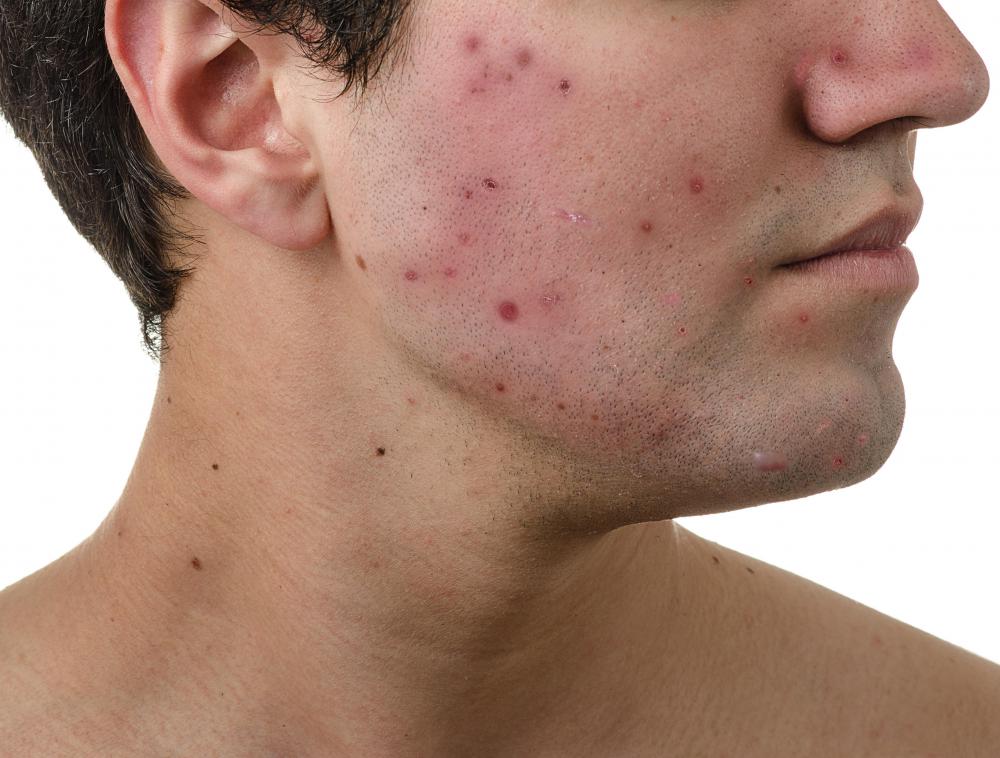 Microdermabrasion may be helpful in reducing the appearance of acne scars.