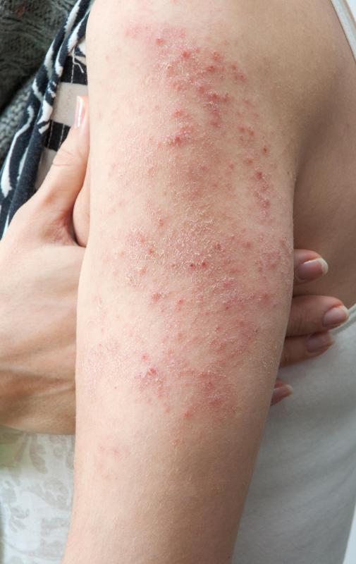 Isopropyl palmitate may cause skin flare-ups.