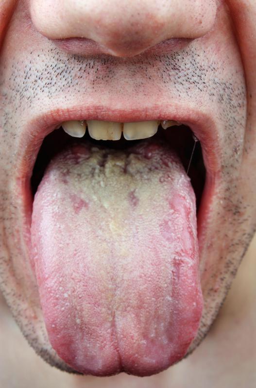 A yeast infection may occur in the mouth.
