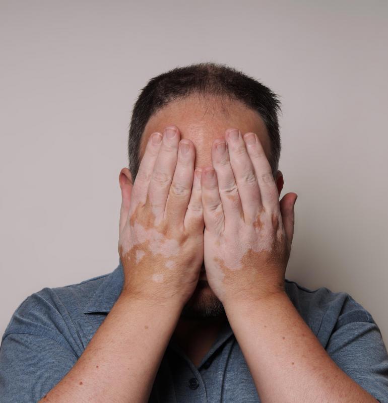 Pancake makeup can be used to cover skin discolorations caused by vitiligo.