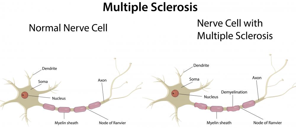 Heloderma extract has been used in the treatment of multiple sclerosis.