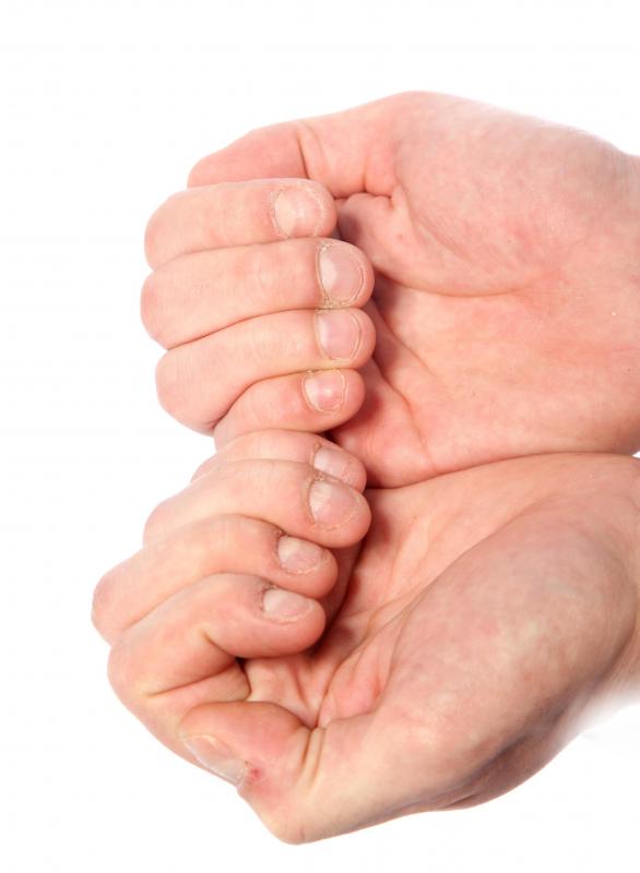 Most of the time, fingernail lines are normal and do not indicate underlying health issues.