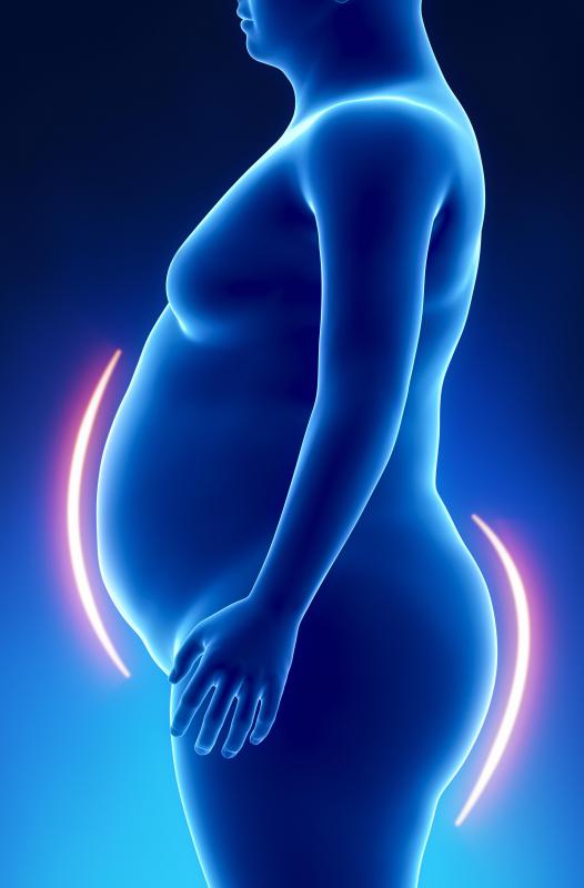 Obesity may increase the chances for atherosclerosis.