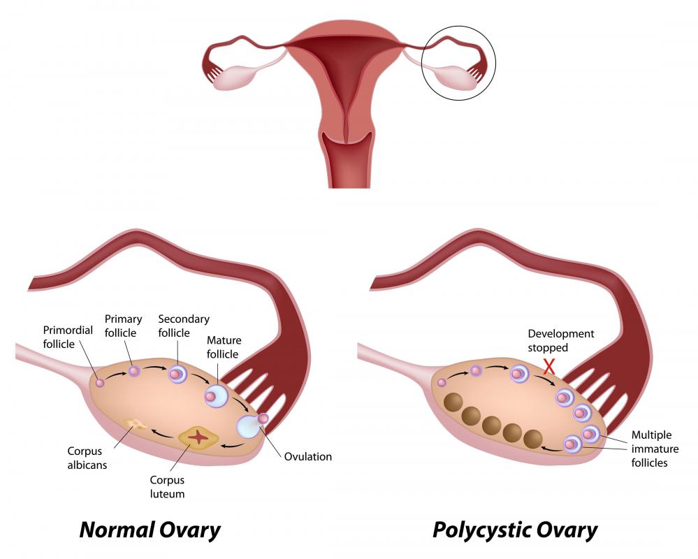 A example of a healthy ovary and one with ovarian cysts.