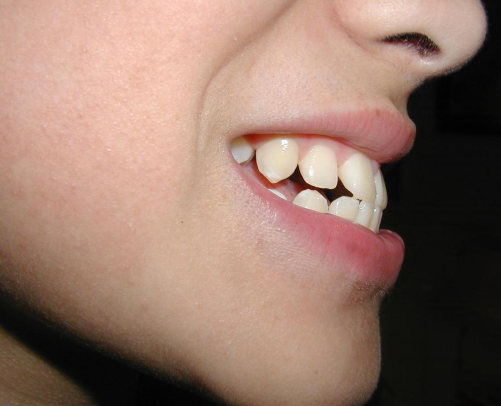 Cosmetic dentistry may be used to correct a dental problem such as an overbite.